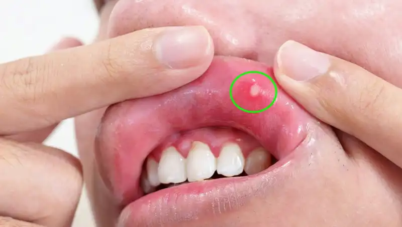 B Vitaminleri Eksikliği: Belirtilerini Tanıyın ve Önlem Alın!